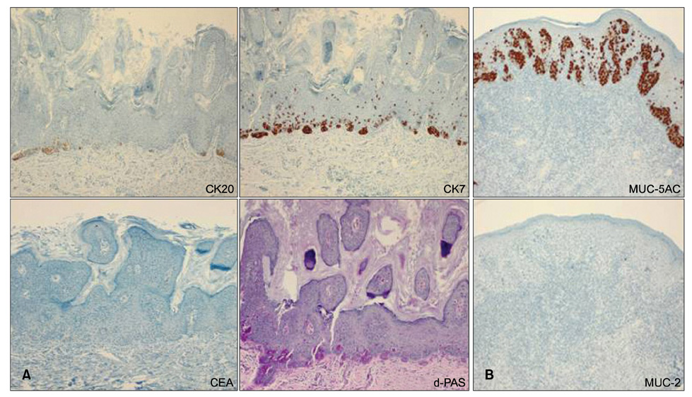 Ck7+ ck20+ tumors