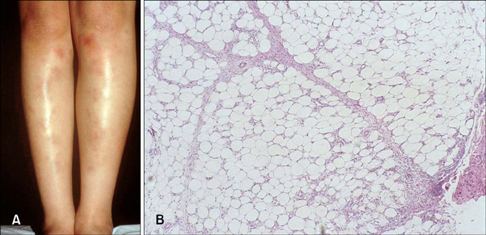 erythema nodosum legs
