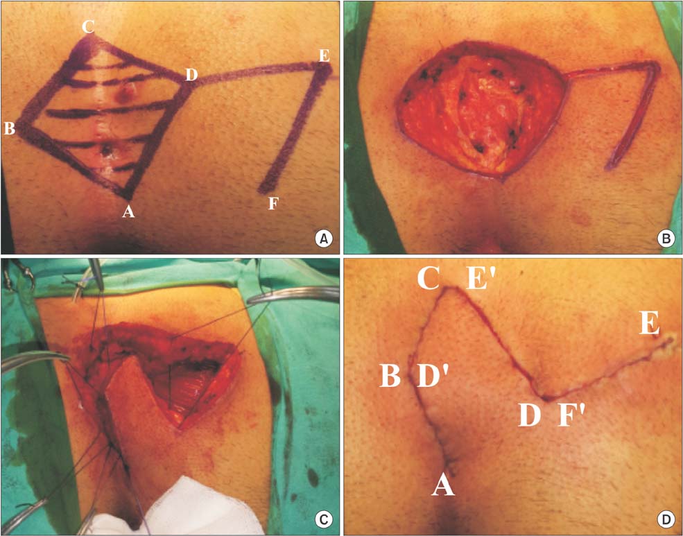 a, b, c. A. Marking of the incision containing the pilonidal cyst and 2