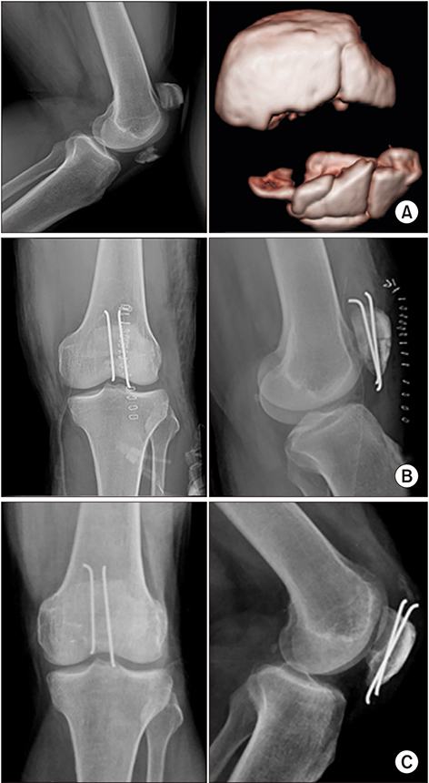 patella fracture classification