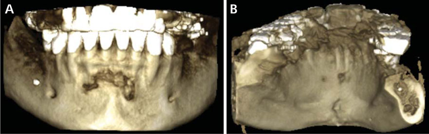 periapical cemento osseous dysplasia