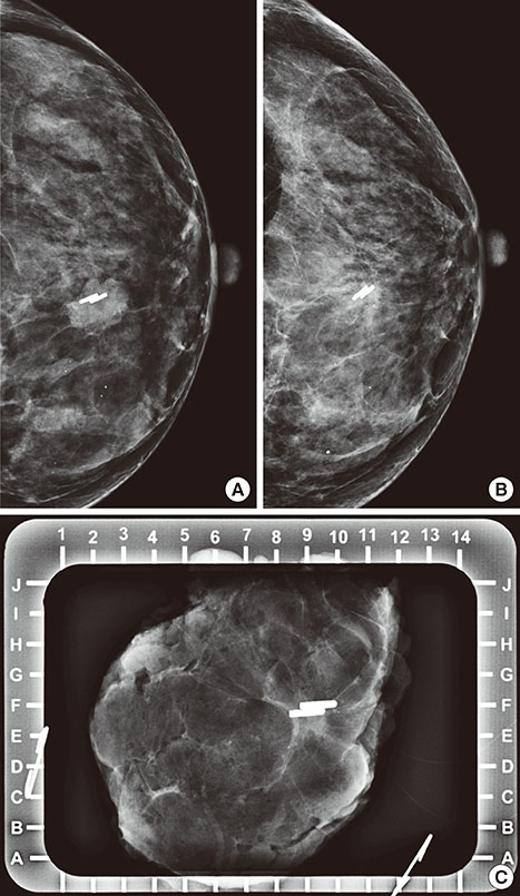 Surgical clips -Mammogram shows linear radiopaque clips, placed during