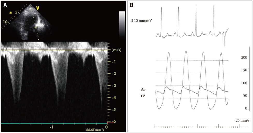 LVOT gradient in HOCM – Doppler echocardiogram – All About