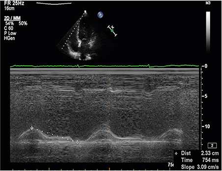 Validation of the Tricuspid Annular Plane Systolic Excursion