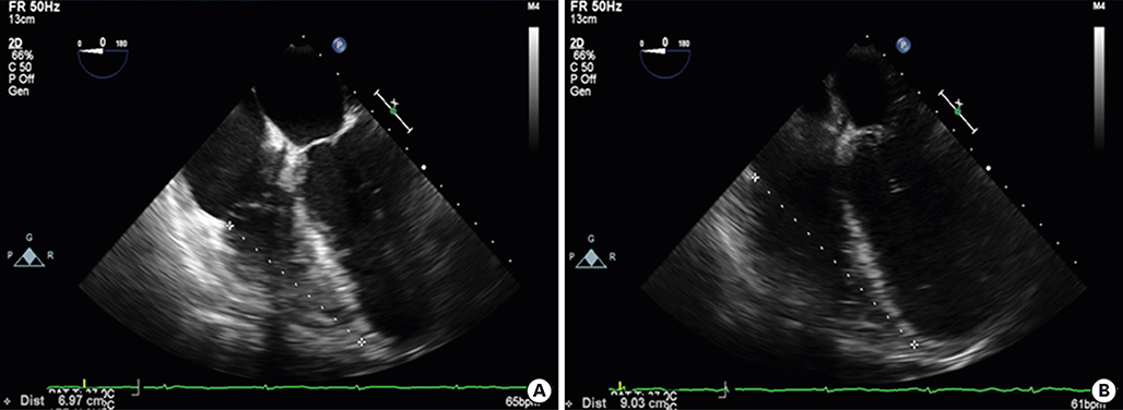 Validation of the Tricuspid Annular Plane Systolic Excursion