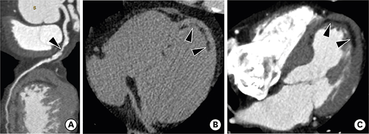 Severe global hypokinesia with akinesis of the anterior, antero-lateral