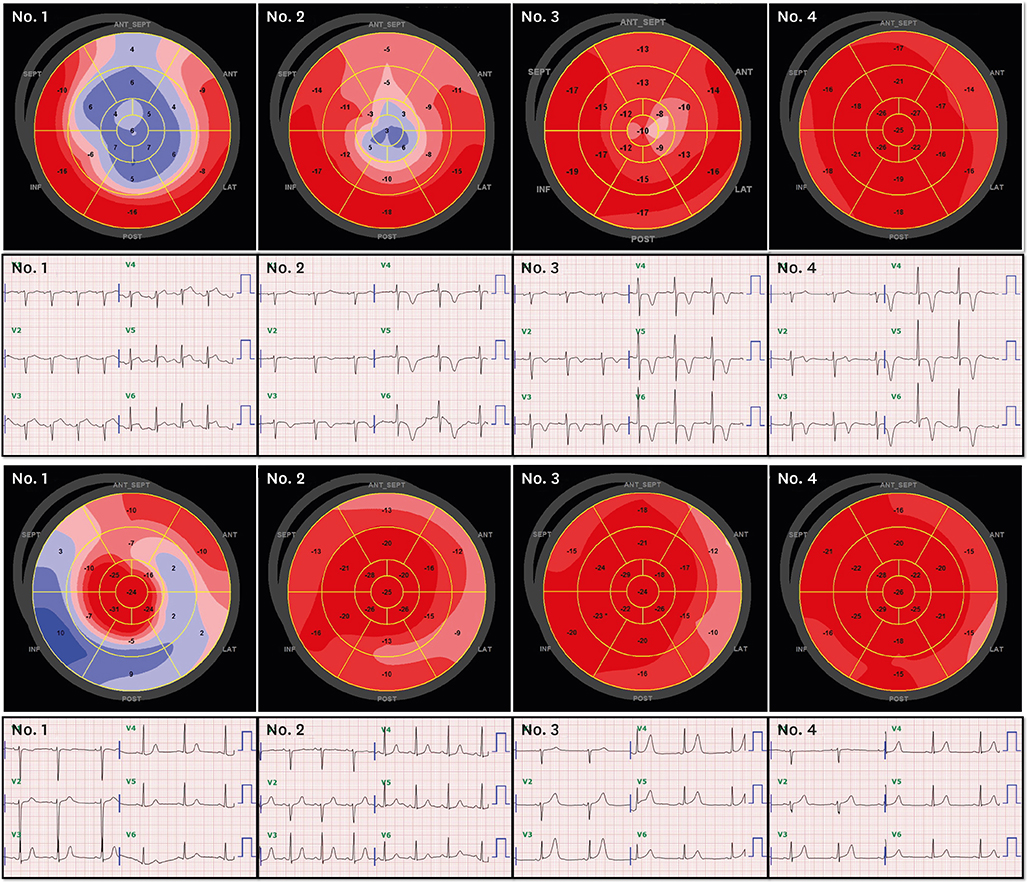 Bull's eye images of left ventricular global longitudinal strain