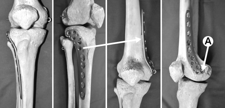 medial femoral condyle fracture
