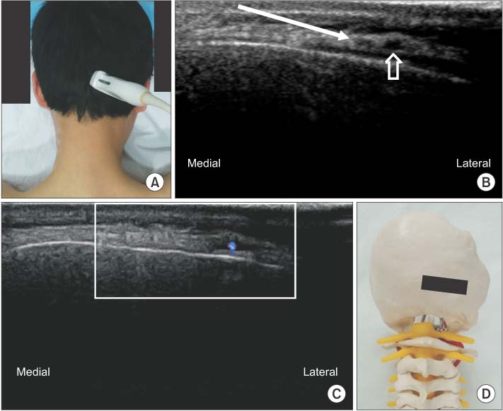 Real-World Retrospective Review of Axial Neck Pain Relief Following  Peripheral Nerve Stimulation of Cervical Medial Branch Nerves – SPR  Therapeutics