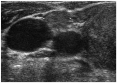 papillary thyroid cancer ultrasound
