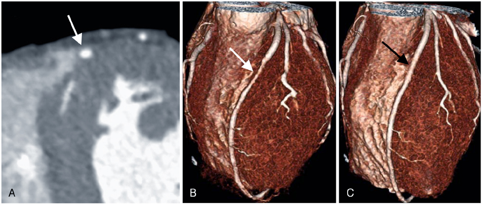 Update on Myocardial Bridging