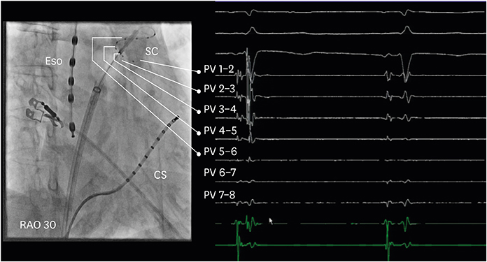 Homogenous, clear-cut, 3-h-old lesion of transmural coagulation