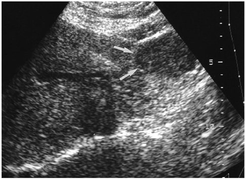cavernous hemangioma liver ultrasound