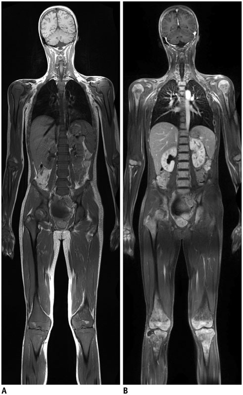 Full Body MRI Scan