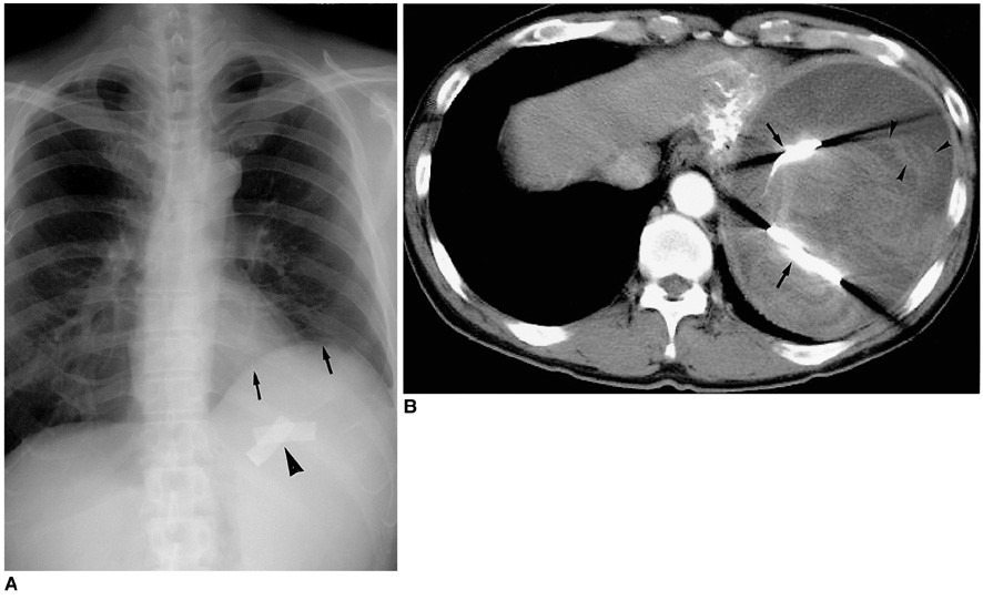 Surgical clips -Mammogram shows linear radiopaque clips, placed during