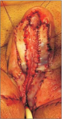 a Large penile skin defect after debridement at full stretch. b Penile