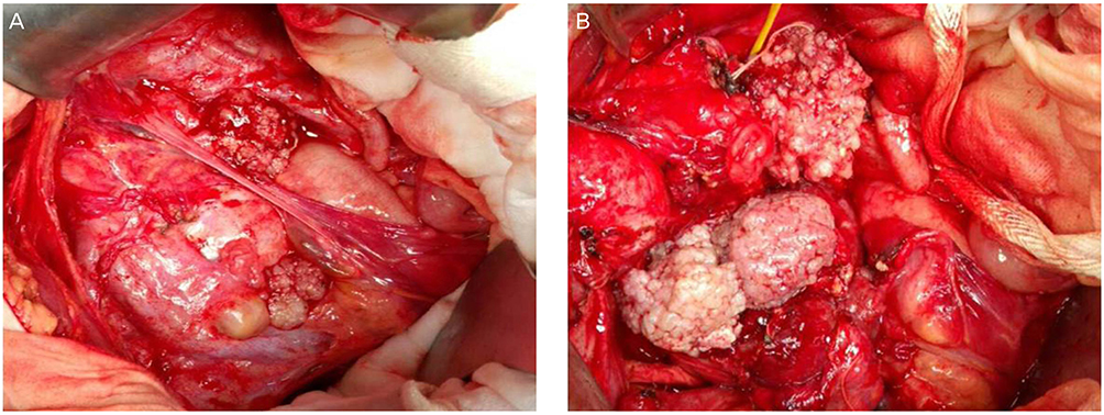 PDF) Factors associated with misdiagnosis of frozen section of mucinous  borderline ovarian tumor