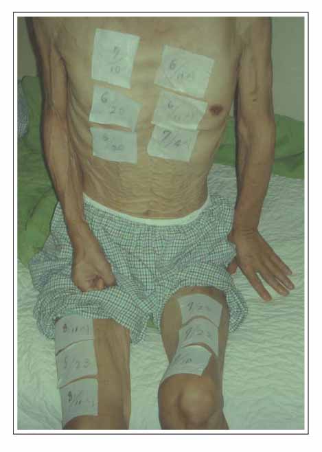 Twelve patches of transdermal fentanly (Durogesic D-trans ® 50µg/hr)