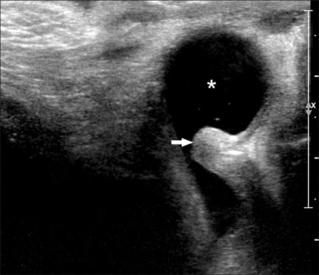 urethral diverticulum ultrasound