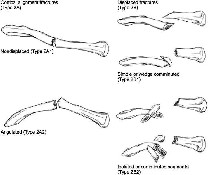 clavicle fracture classification