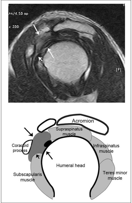 coracohumeral ligament mri