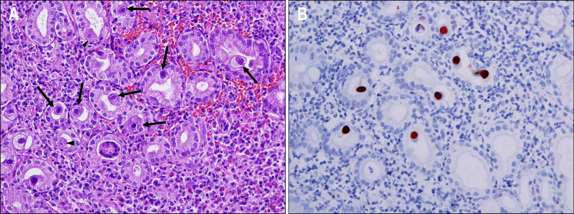 reed sternberg cells vs cmv