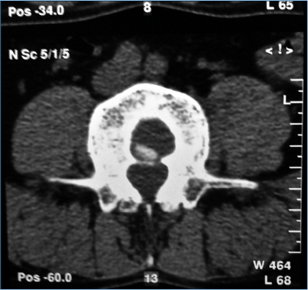 jkns-60-2-269f2.gif