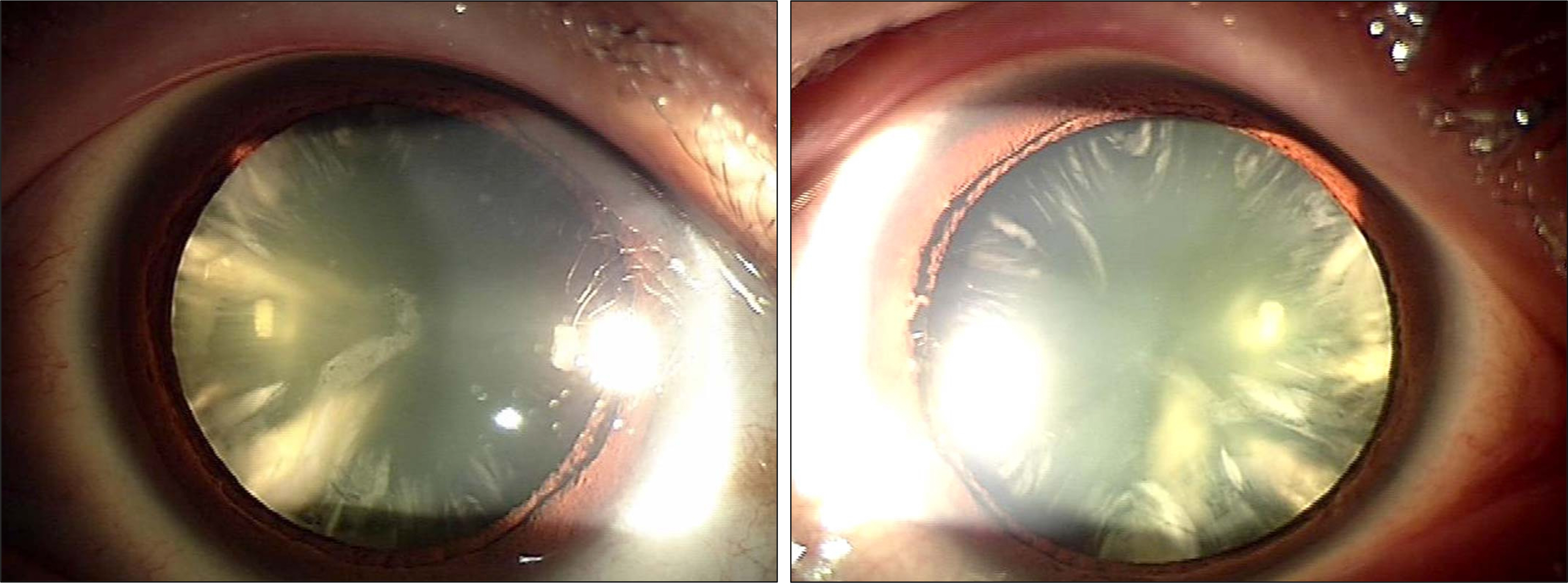 anterior capsular cataract