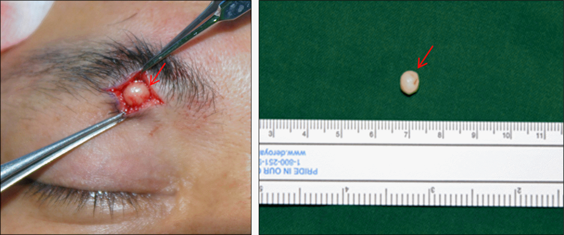 eruptive vellus hair cysts face