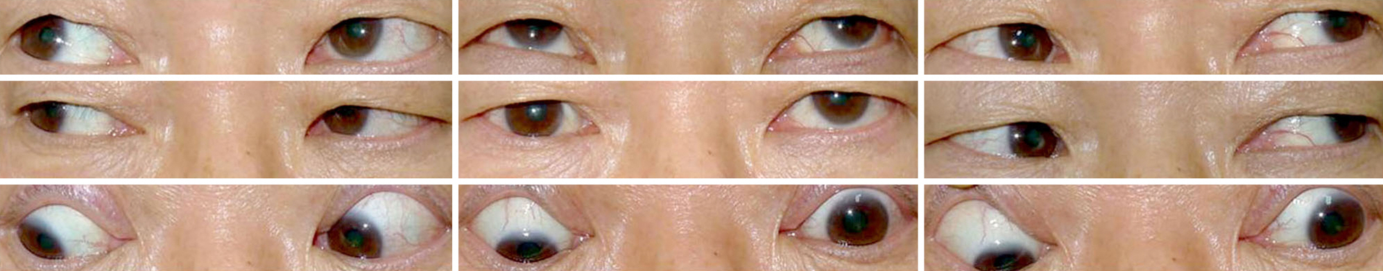 Preoperative clinical 9 gaze photographs of the patient showing over