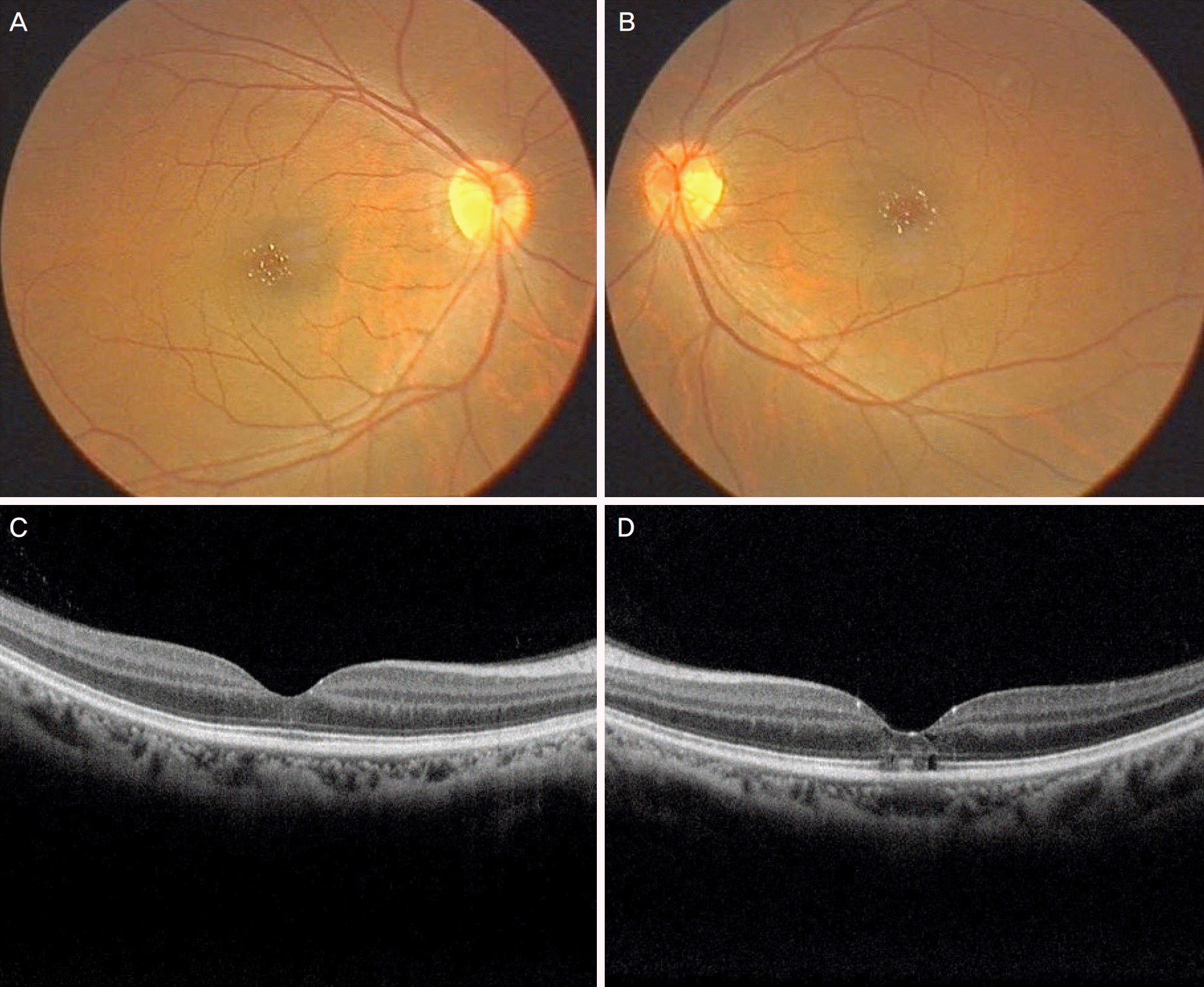 crystalline retinopathy tamoxifen