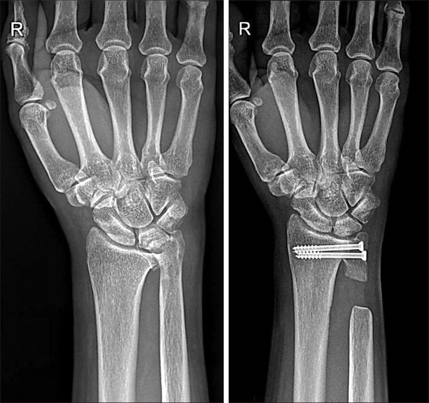 distal radioulnar joint x ray