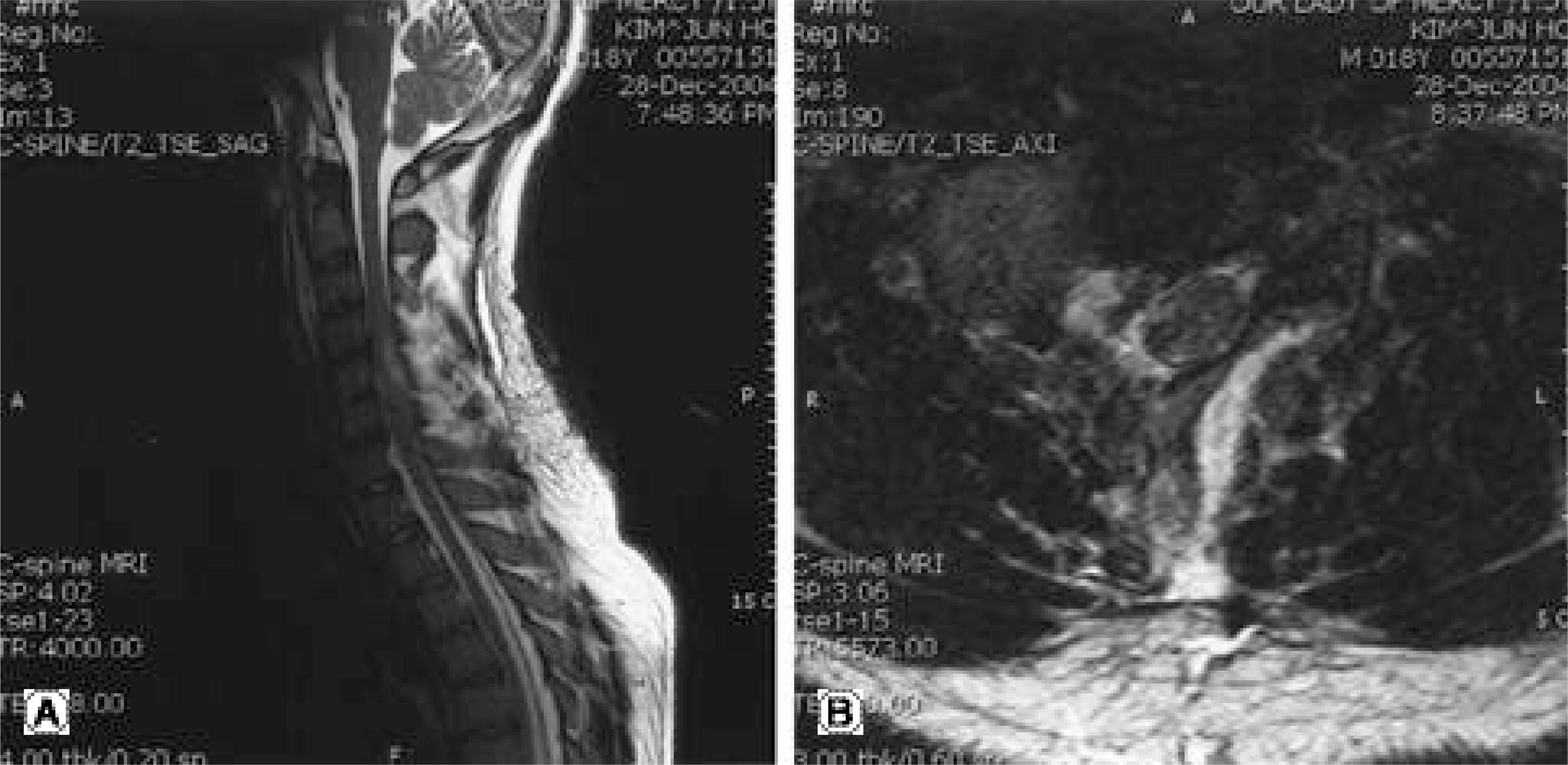 Hereditary multiple exostoses with spinal cord compression.