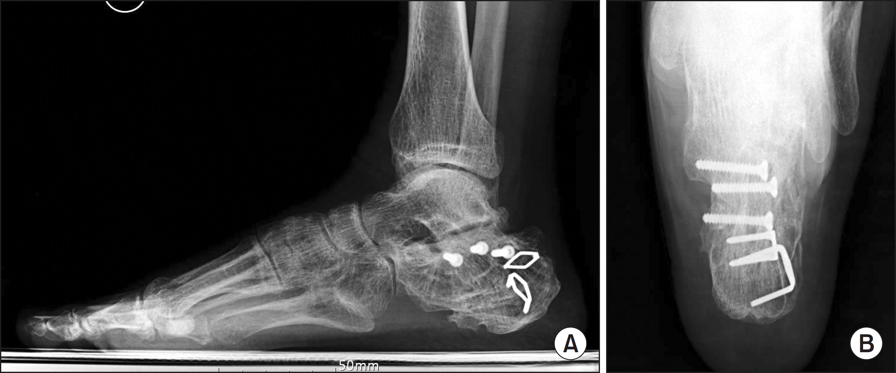 Technical Tip: A Simple Method for Proper Placement of an Intramedullary  Nail Entry Point for Tibiotalocalcaneal or Tibiocalcaneal Arthrodesis | The  Foot and Ankle Online Journal