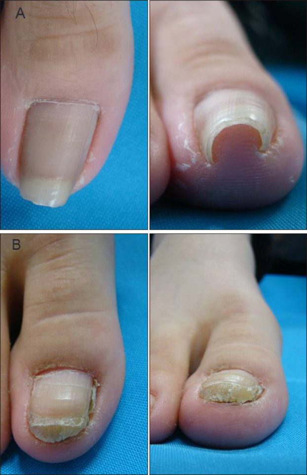 A Improvement of pincer nail after three sessions of nail grinding   Download Scientific Diagram