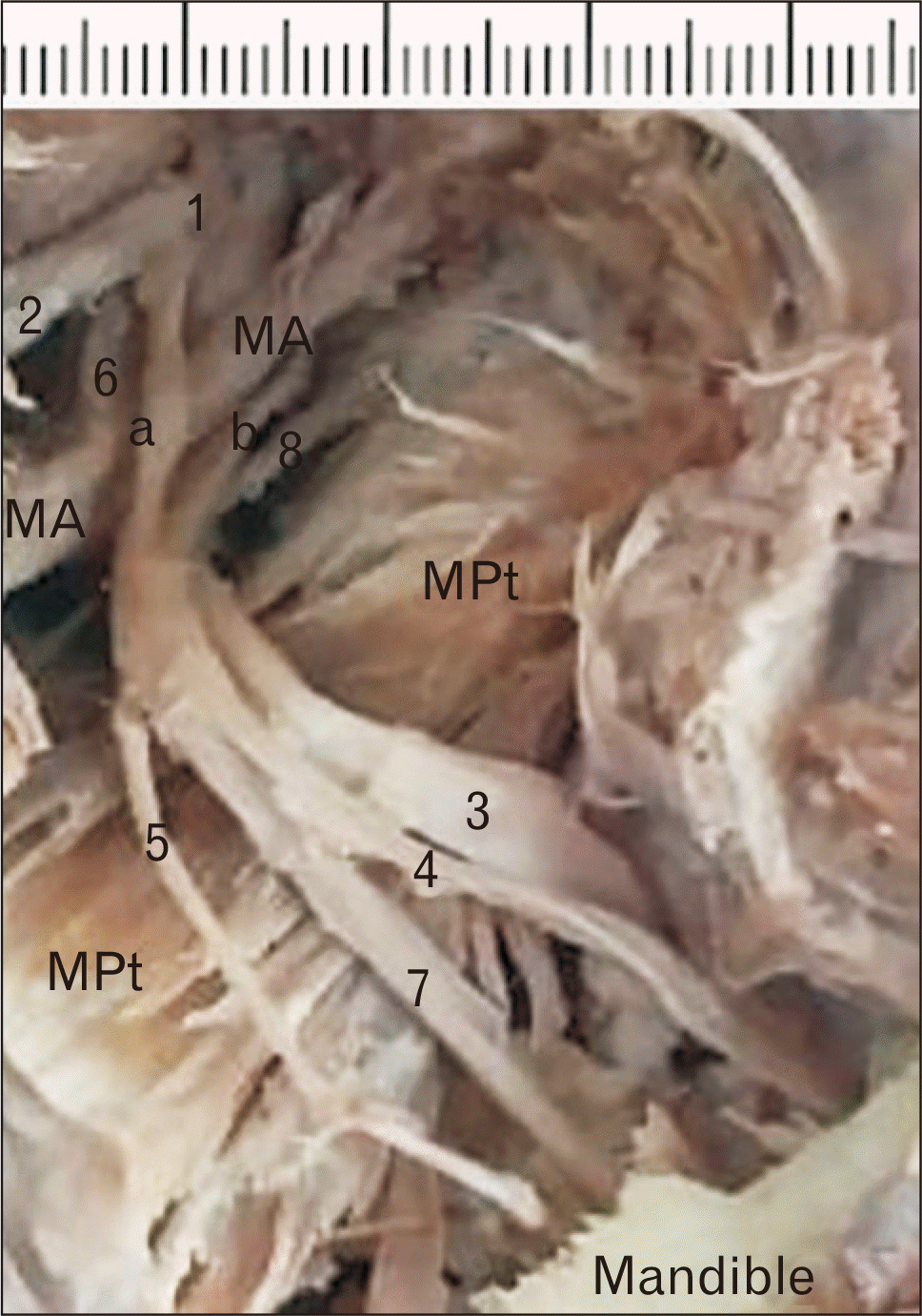a) Anatomic overview of the posterior division of the mandibular nerve