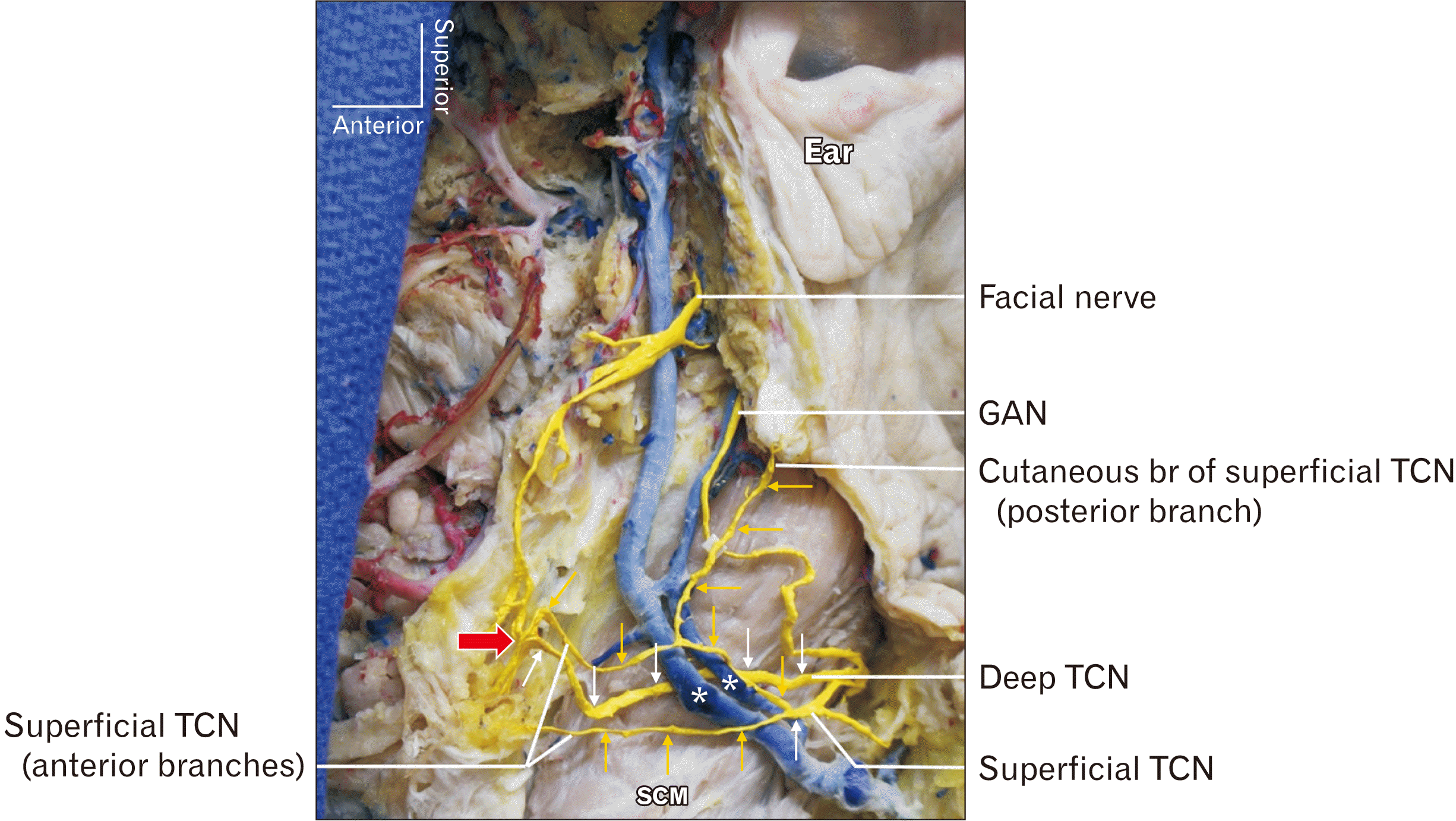 mandibular nerve cadaver