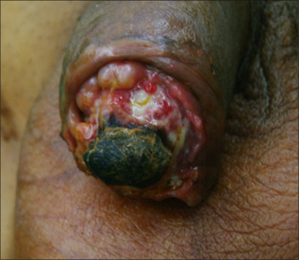 Painful ulcers on the penis