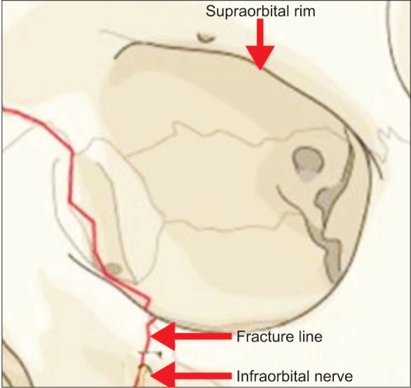 infraorbital nerve