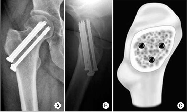 femoral neck fracture cannulated screws